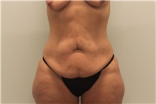 Tummy Tuck Before Photo by Ravi Somayazula, DO; Houston, TX - Case 36626