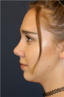 Rhinoplasty After Photo by Steve Laverson, MD, FACS; Rancho Santa Fe, CA - Case 36810