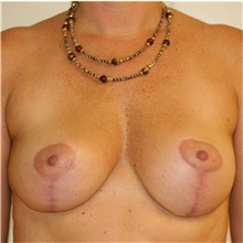 Breast Lift After Photo by Steve Laverson, MD, FACS; Rancho Santa Fe, CA - Case 36880