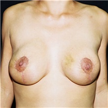 Breast Lift After Photo by Steve Laverson, MD, FACS; Rancho Santa Fe, CA - Case 36882