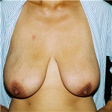Breast Lift Before Photo by Steve Laverson, MD, FACS; Rancho Santa Fe, CA - Case 36882