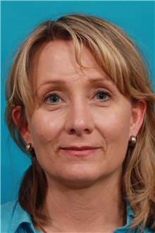 Brow Lift After Photo by Michael Bogdan, MD, MBA, FACS; Grapevine, TX - Case 36906