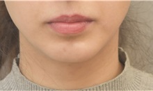 Chin Augmentation After Photo by Keshav Magge, MD; Bethesda, MD - Case 37012