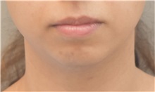 Chin Augmentation Before Photo by Keshav Magge, MD; Bethesda, MD - Case 37012