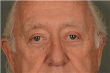 Eyelid Surgery After Photo by Ellen Janetzke, MD; Bloomfield Hills, MI - Case 37637