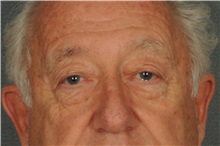 Eyelid Surgery Before Photo by Ellen Janetzke, MD; Bloomfield Hills, MI - Case 37637