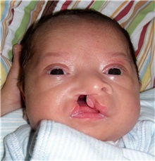 Cleft Lip and Palate Repair Before Photo by Rachel Ruotolo, MD; Garden City, NY - Case 37791