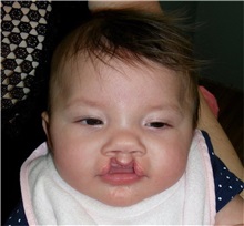 Cleft Lip and Palate Repair Before Photo by Rachel Ruotolo, MD; Garden City, NY - Case 38033