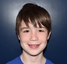 Cleft Lip and Palate Repair After Photo by Rachel Ruotolo, MD; Garden City, NY - Case 38034