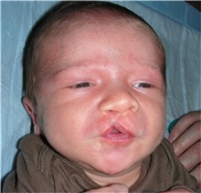 Cleft Lip and Palate Repair Before Photo by Rachel Ruotolo, MD; Garden City, NY - Case 38034
