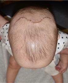 Craniosynostosis After Photo by Rachel Ruotolo, MD; Garden City, NY - Case 38037