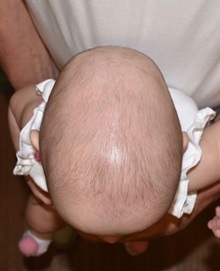Craniosynostosis Before Photo by Rachel Ruotolo, MD; Garden City, NY - Case 38037