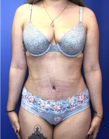 Tummy Tuck After Photo by Mark Markarian, MD, MSPH, FACS; Wellesley, MA - Case 38055