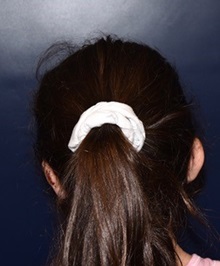 Ear Surgery After Photo by Rachel Ruotolo, MD; Garden City, NY - Case 38128