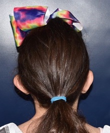 Ear Surgery Before Photo by Rachel Ruotolo, MD; Garden City, NY - Case 38128