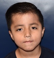 Craniosynostosis After Photo by Rachel Ruotolo, MD; Garden City, NY - Case 38135