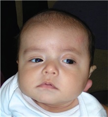 Craniosynostosis Before Photo by Rachel Ruotolo, MD; Garden City, NY - Case 38135