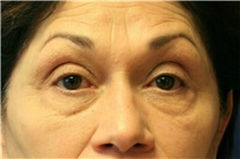 Eyelid Surgery Before Photo by Steve Laverson, MD, FACS; Rancho Santa Fe, CA - Case 38178