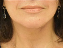Facelift After Photo by Richard Reish, MD, FACS; New York, NY - Case 38257