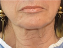 Facelift Before Photo by Richard Reish, MD, FACS; New York, NY - Case 38257