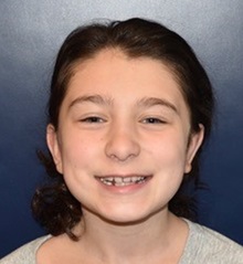 Ear Surgery After Photo by Rachel Ruotolo, MD; Garden City, NY - Case 38310