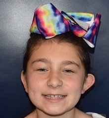 Ear Surgery Before Photo by Rachel Ruotolo, MD; Garden City, NY - Case 38310