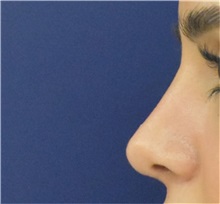 Rhinoplasty After Photo by Richard Reish, MD, FACS; New York, NY - Case 38329