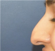Rhinoplasty Before Photo by Richard Reish, MD, FACS; New York, NY - Case 38329