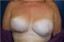 Breast Reconstruction Before Photo by Michael Dobryansky, MD, FACS; Garden City, NY - Case 38376