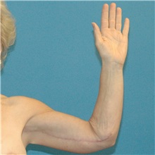Arm Lift After Photo by Scott Sattler, MD,  FACS; Seattle, WA - Case 38411