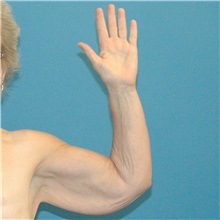 Arm Lift Before Photo by Scott Sattler, MD,  FACS; Seattle, WA - Case 38411