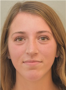 Chin Augmentation After Photo by Keshav Magge, MD; Bethesda, MD - Case 38571