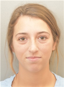 Chin Augmentation Before Photo by Keshav Magge, MD; Bethesda, MD - Case 38571