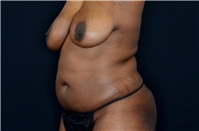 Body Contouring Before Photo by Landon Pryor, MD, FACS; Rockford, IL - Case 38842