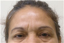 Brow Lift Before Photo by Mariam Awada, MD, FACS; Southfield, MI - Case 38880