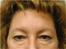 Brow Lift Before Photo by Mariam Awada, MD, FACS; Southfield, MI - Case 38882