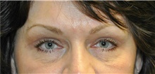 Eyelid Surgery After Photo by Karol Gutowski, MD, FACS; Glenview, IL - Case 39150
