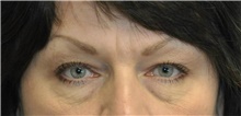 Eyelid Surgery Before Photo by Karol Gutowski, MD, FACS; Glenview, IL - Case 39150