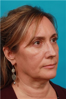 Eyelid Surgery After Photo by Michael Bogdan, MD, MBA, FACS; Grapevine, TX - Case 39198