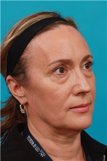 Eyelid Surgery Before Photo by Michael Bogdan, MD, MBA, FACS; Grapevine, TX - Case 39198