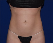 Liposuction Before Photo by Karol Gutowski, MD, FACS; Glenview, IL - Case 39239