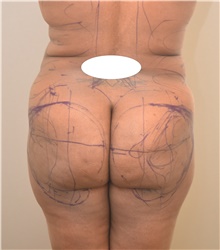 Buttock Lift with Augmentation Before Photo by Keshav Magge, MD; Bethesda, MD - Case 39352