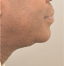 Chin Augmentation After Photo by Keshav Magge, MD; Bethesda, MD - Case 39639