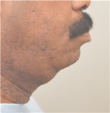 Chin Augmentation Before Photo by Keshav Magge, MD; Bethesda, MD - Case 39639