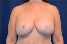 Breast Reconstruction After Photo by Michael Frederick, MD; Fort Lauderdale, FL - Case 39799