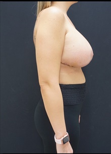 Breast Lift After Photo by Johnny Franco, MD; Austin, TX - Case 39941