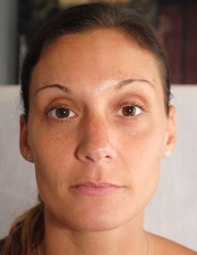 Botulinum Toxin After Photo by Ellen Mahony, MD; Westport, CT - Case 40187