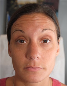 Botulinum Toxin Before Photo by Ellen Mahony, MD; Westport, CT - Case 40187