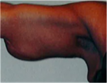 Arm Lift Before Photo by Mariam Awada, MD, FACS; Southfield, MI - Case 40209