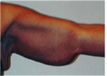 Arm Lift Before Photo by Mariam Awada, MD, FACS; Southfield, MI - Case 40210